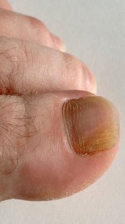 nail fungus