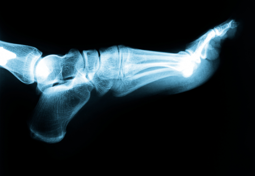  When individuals begin to experience intense pain in their heel, many know that they have acquired plantar fasciitis. This ailment occurs when the plantar fascia ligament along the bottom of the foot develops tears in the tissue. This will result in pain and inflammation of the area closest to the heel bone.   The most common symptoms of plantar fasciitis include:  Burning Stabbing An aching pain in the heel of the foot  The fascia ligament tightens up over night and therefore causes the most pain in the morning. Pain generally decreases as the tissue warms up, but oftentimes returns after long periods of standing or weight bearing and physical activity.   One of the prevalent factors that contribute to plantar fasciitis is wearing incorrect shoes. This includes shoes that either don’t fit properly, or provide inadequate support or cushioning. Weight distribution becomes impaired while wearing shoes that are unsupportive. Therein, adding significantly stress to the plantar fascia ligament.   In most cases, treatment of plantar fasciitis doesn’t require surgery or invasive procedures to stop pain and reverse damage. Traditional treatments are usually all that is required. However, keep in mind that every person's body responds to the treatment differently and recovery times will vary.  Auburn Podiatrist | Auburn Plantar Fasciitis | CA | Amanda Matz, DPM |